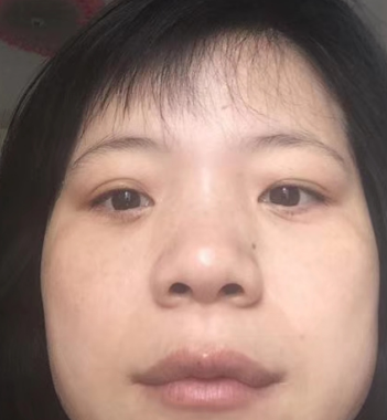 去眼袋手术