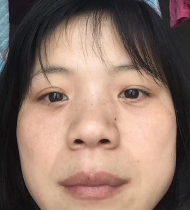 去眼袋手术