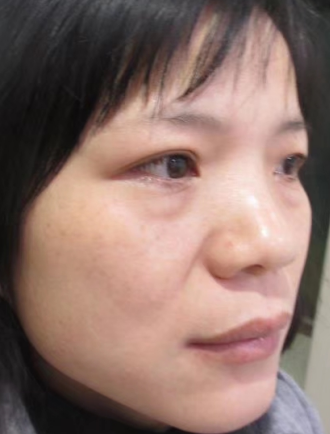 去眼袋手术