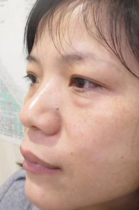 去眼袋手术