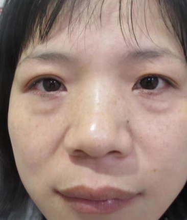 去眼袋手术