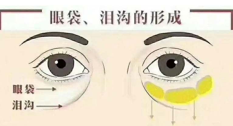 去眼袋手术