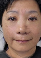去眼袋手术