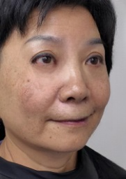 去眼袋手术