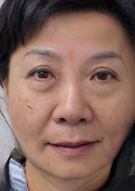 去眼袋手术