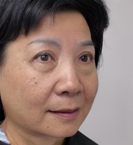 去眼袋手术