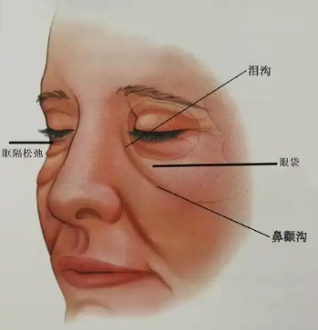 去眼袋手术