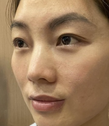 去眼袋手术