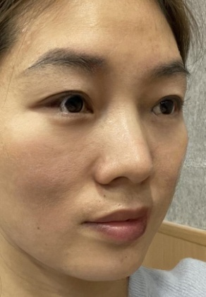去眼袋手术