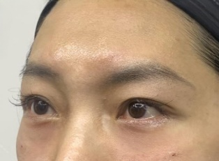 去眼袋手术