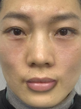 去眼袋手术