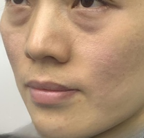 去眼袋手术