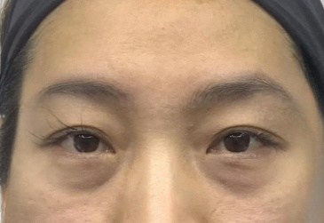 去眼袋手术