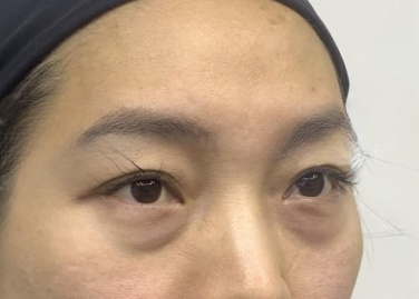 去眼袋手术