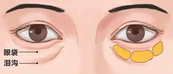 去眼袋手术