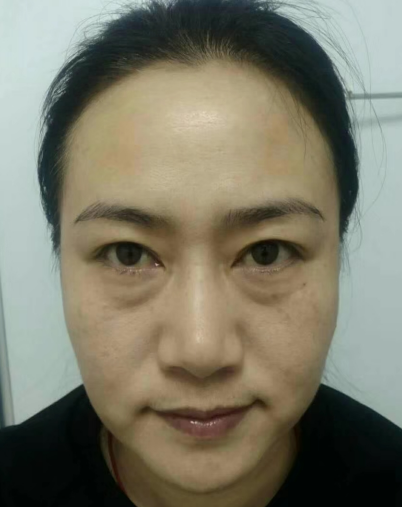 去眼袋手术