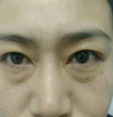 去眼袋手术