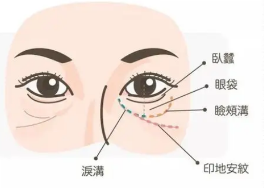 去眼袋手术