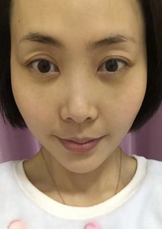 去眼袋手术