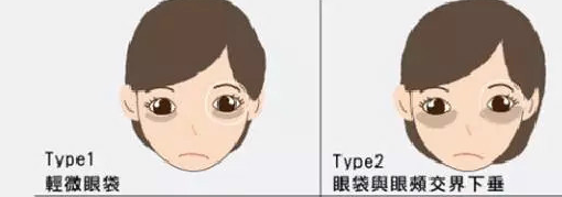 去眼袋手术