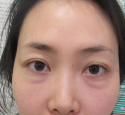 去眼袋手术