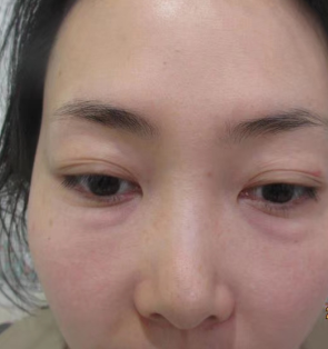 去眼袋手术
