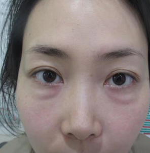 去眼袋手术