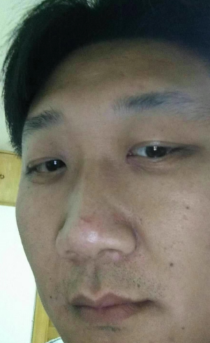 去眼袋手术