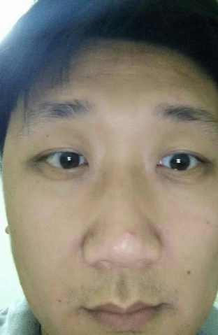 去眼袋手术