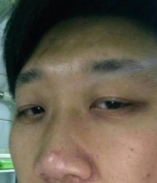 去眼袋手术