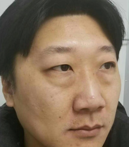 去眼袋手术