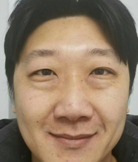 去眼袋手术