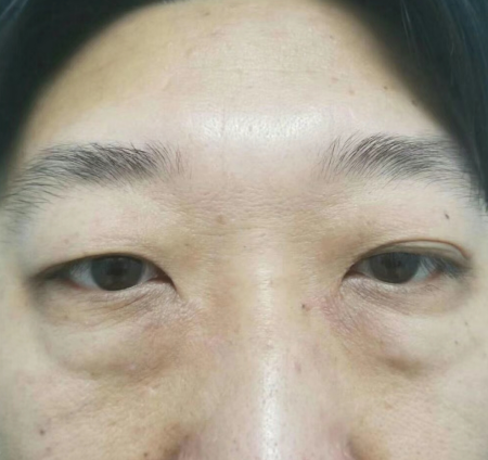 去眼袋手术