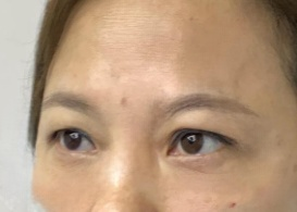 去眼袋手术