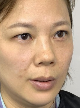 去眼袋手术