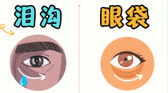 去眼袋手术