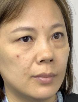 去眼袋手术