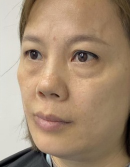 去眼袋手术