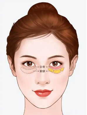 去眼袋手术