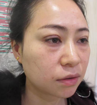 去眼袋手术