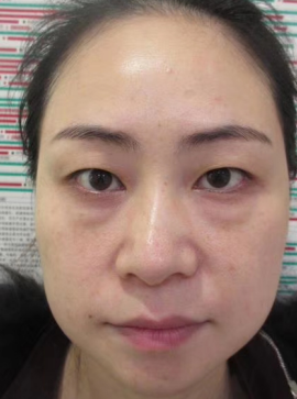 去眼袋手术