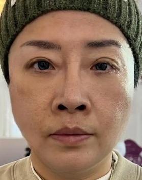 去眼袋手术