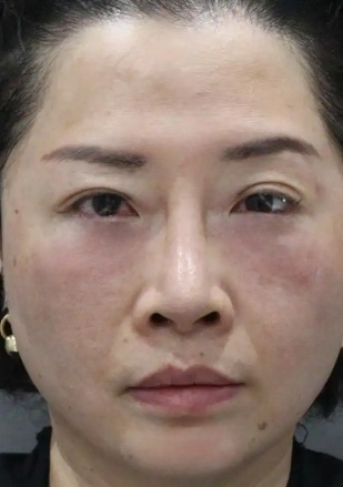 去眼袋手术