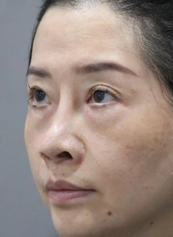 去眼袋手术