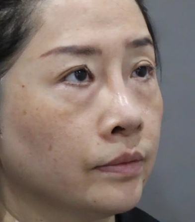 去眼袋手术