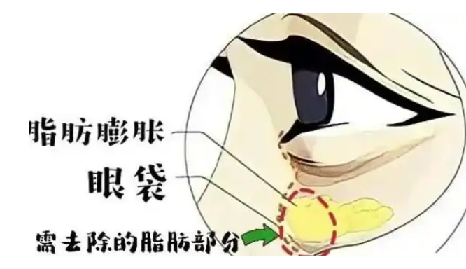 去眼袋手术