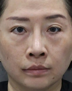 去眼袋手术