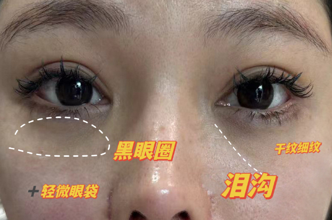 眼袋