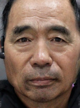 去眼袋手术