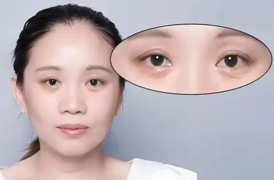 去眼袋手术